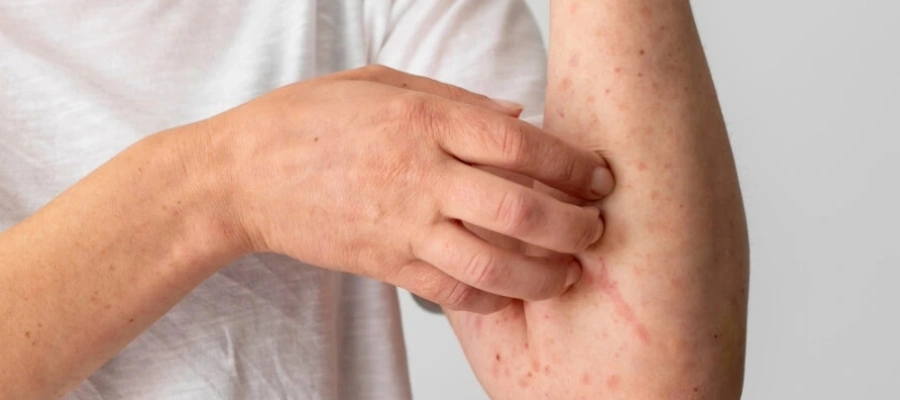 melhores cremes para bolinhas no braço que coçam