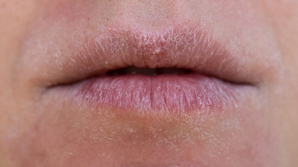erros comuns ao tratar lábios ressecados pelo frio